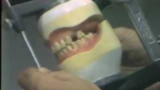 Setting Posterior 0 Versus 0 Degree Artificial Teeth