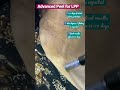 Advanced Peel for LPP I Dr Ashima Goel I  dermatologist in chandigarh #shorts