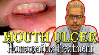 Mouth Ulcer in Hindi - Discussion and Treatment in Homeopathy by Dr P.S. Tiwari