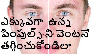 CTelugu - అందమే ఆనందం  - 5 step process for excess pimples on face by CTelugu