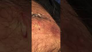 THE JUICIEST CYST! | PT 2