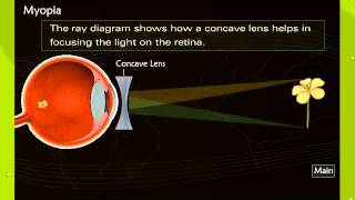 Human Eye Refractive Errors
