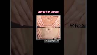 늘어진 피부 튼살에 플라즈마 하세요 #shorts #플라즈마 #튼살 #뱃살 #다이어트 #추천 #강남플라즈마