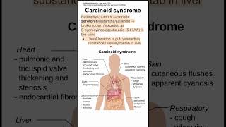 Carcinoid syndrome