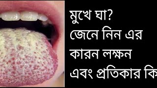 মুখে ঘা বা ফাংগাল ইনফেকশন?  জেনে নিন এর কারন,  লক্ষন এবং প্রতিকার!!