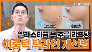 이중턱 교정.. 만족스럽지 않았다면?🤨 엘라스티꿈 목 주름 리프팅을 추천합니다!😉ㅣ제스타 성형외과