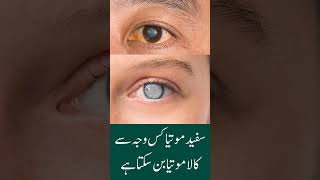 Can untreated cataracts lead to glaucoma | in Urdu Hindi