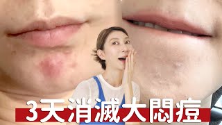 《3天消滅大悶痘》只要用人工皮+水楊酸｜Astor