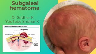 Subgaleal hematoma in babies. Serious condition-not to miss! Dr Sridhar Kalyanasundaram