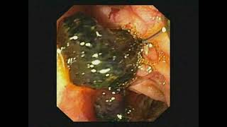 ERCP- Pancreatic Duct Stone removed