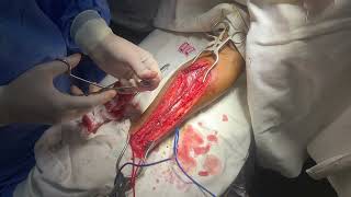 RADIAL ARTERY harvesting for CABG (Radial Artery Conduit)