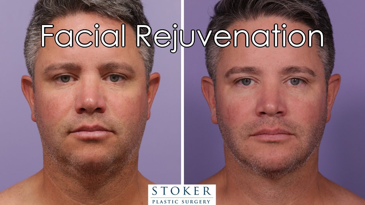 Male Chin Augmentation, Chin Liposuction And Buccal Fat Reduction: Los ...