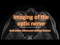 Imaging of the optic nerve