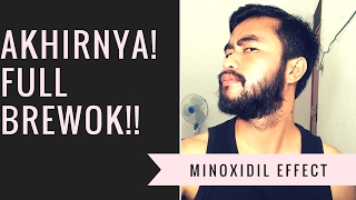 Minggu Ke 7 - 15 | AKHIRNYA!! FULL BREWOK | Menumbuhkan Brewok Dengan Minoxidil