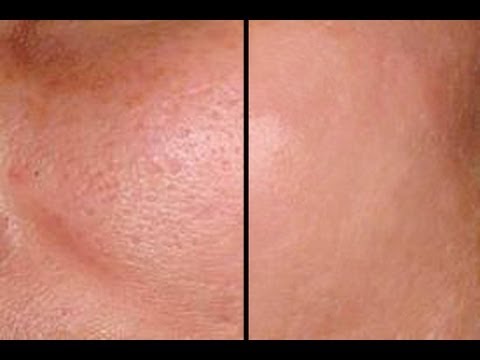 HOW TO: MAKE PORES DISAPPEAR IN SECONDS - GOOD FOR ACNE PRONE SKIN! HOW TO: MAKE PORES DISAPPEAR IN SECONDS - GOOD FOR ACNE PRONE SKIN!