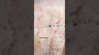 Firefighter Blackheads 👨‍🚒 | Dr. Pimple Popper #drpimplepopper #shorts #pimple #blackheads