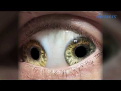 Rare Eye Conditions You Have To See To Believe Rare Eye Conditions You Have To See To Believe