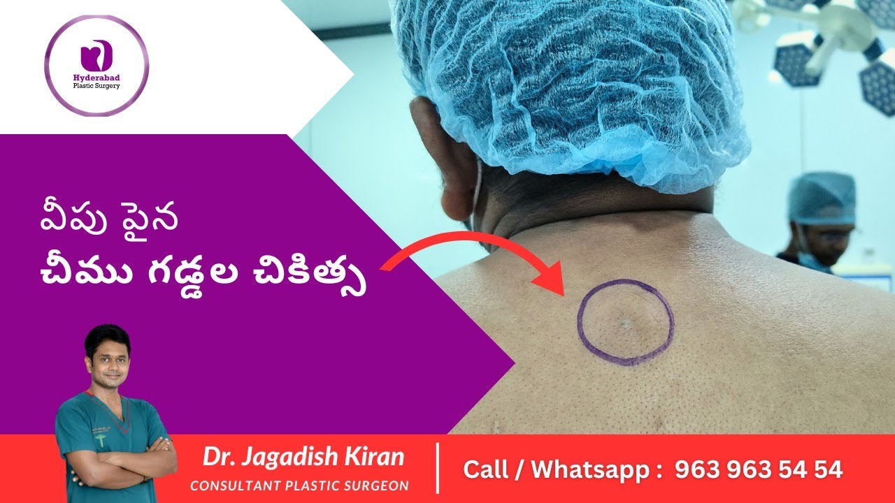 Low Cost Sebaceous Cyst Removal In Hyderabad | Understanding Back Cysts ...