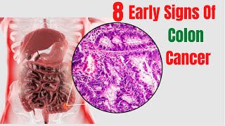 Top 8 Early Warning Signs Of Colon Cancer - Colon Cancer First Stage
