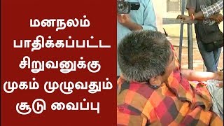 மனநலம் பாதிக்கப்பட்ட சிறுவனுக்கு முகம் முழுவதும் சூடு வைப்பு | #Coimbatore