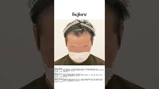 【衝撃】AGA治療のbefore/afterが凄すぎたwww