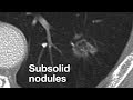 Subsolid Nodules