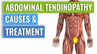 Abdominal Tendinopathy - Causes and Treatment, Including Exercises
