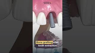 Bone grafting after tooth extraction in dental implant procedure turkey