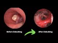 Bronchoscopic Resection of Lung Carcinoid Tumour