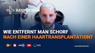 Wie entfernt man Schorf nach einer Haartransplantation? - BANK OF HAIR