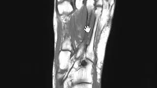 Metatarsal stress fracture by MRI