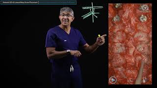 Surgical Techniques: Subaxial C3-6 Lateral Mass Screws