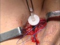 Bilateral readjustement of Transobturator crossover sling