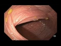 small bowel benign findings massive small bowel dilation from motility disorder