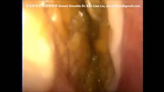 嚴重的鼻竇炎  Very Severe Sinusitis 劉耿僚醫師