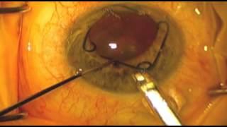 Malyugin Ring® Insertion and Removal