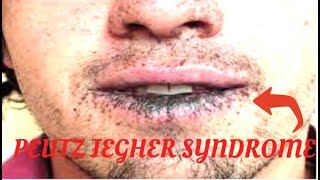 PEUTZ JEGHERS SYNDROME : What is Peutz Jeghers syndrome? + Symptoms of peutz jeghers syndrome