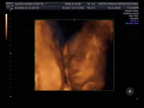 ultrasonido estructural a las 12 semanas