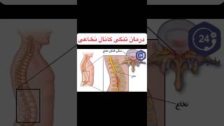 درمان تنگی کانال نخاعی Spinal canal stenosis #massage #viral #sciatica #sciaticanervepain #anatomy