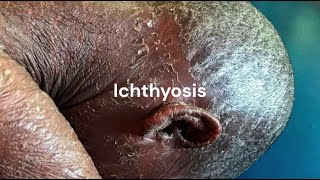 What is Ichthyosis | Ichthyosis Treatment in Homeopathy