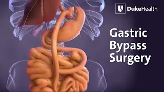 Gastric Bypass Surgery | Duke Health