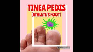 TINEA PEDIS (ATHLETE'S FOOT) #medicine #reels #trending #fungalnails #medicalstudent #athletics #fyp