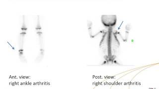 IAEA/ESNM Webinar - Paediatric Non Oncologic Bone Scintigraphy