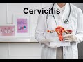 cervicitis 101 understanding causes symptoms and treatment options