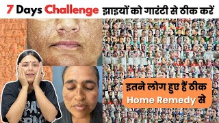 7 दिन में झाइयों में फर्क देखें - पुरानी से पुरानी Pigmentation को ठीक करें | Dr. Upasana Vohra