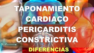 Taponamiento cardiaco vs Pericarditis Constrictiva