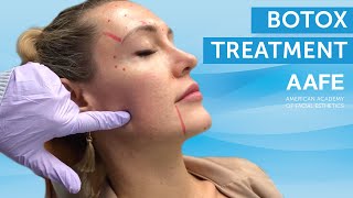 Botox Treatment | AAFE