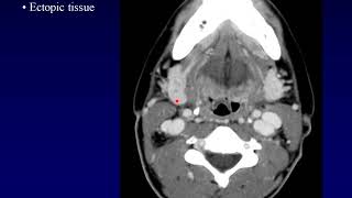 Salivary1