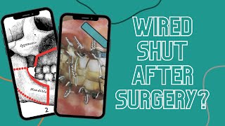 Wired Shut After Jaw Surgery? #shorts