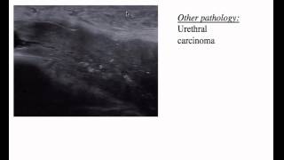 University of Utah Grand Rounds - Anterior Urethral Strictures Part 1